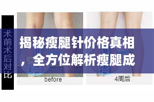 揭秘瘦腿針價(jià)格真相，全方位解析瘦腿成本！