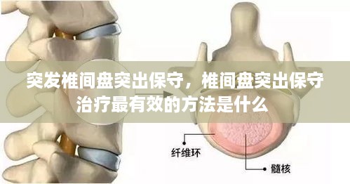 突發(fā)椎間盤突出保守，椎間盤突出保守治療最有效的方法是什么 