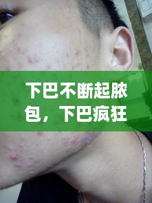 下巴不斷起膿包，下巴瘋狂長膿包 